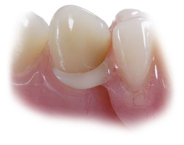 Dentures & False Teeth, Full & Partial - Bakal Dental